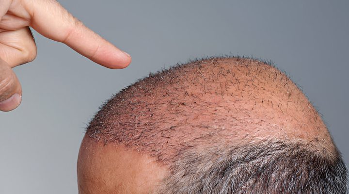 تأخر نمو الشعر المزروع