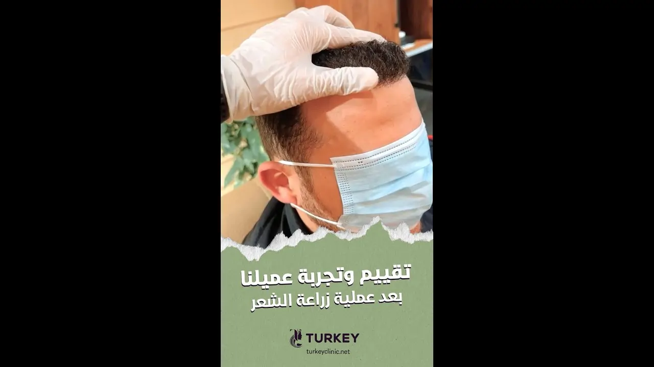 تجربة عملية زراعة الشعر