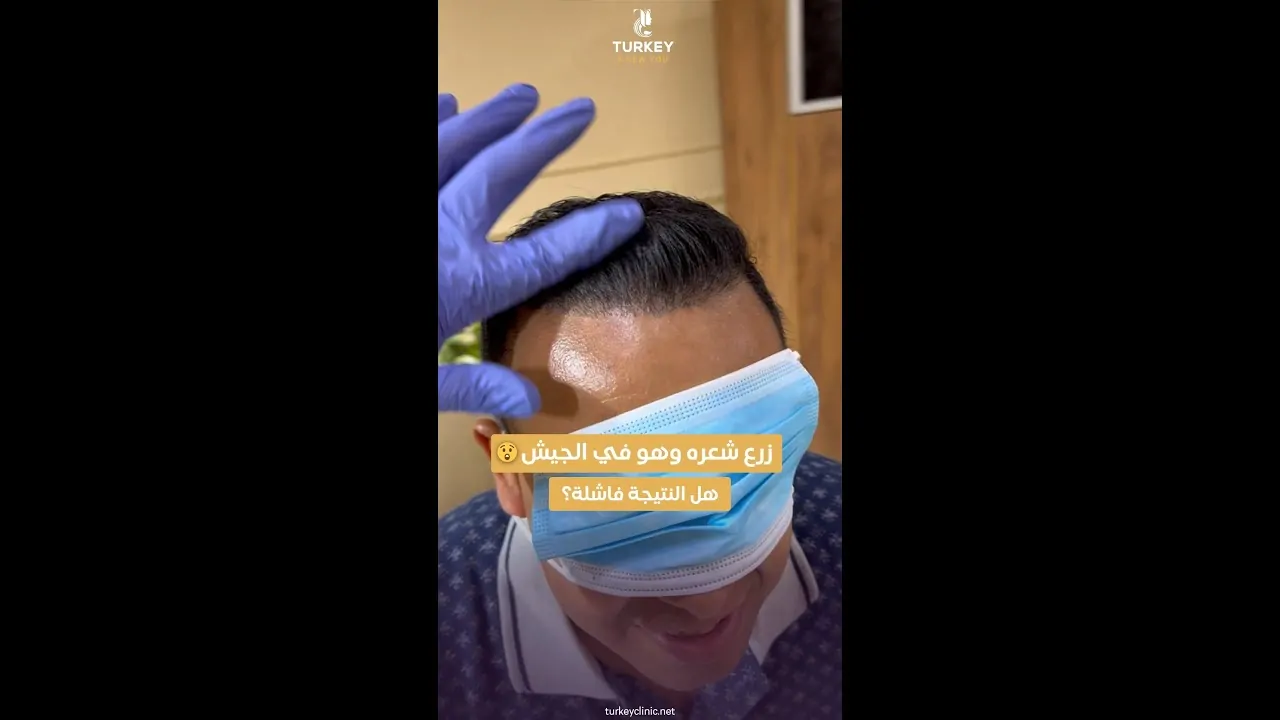 زراعة الشعر في الجيش
