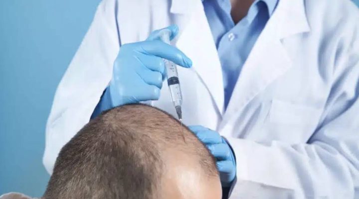 معالجة زراعة الشعر الفاشلة