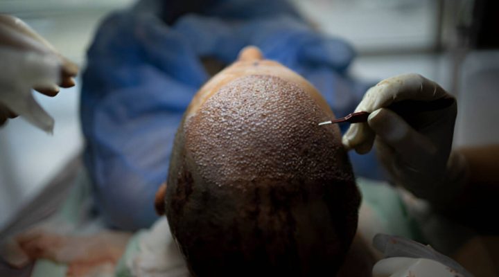 نتائج عملية زراعة الشعر