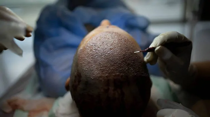 نتائج عملية زراعة الشعر