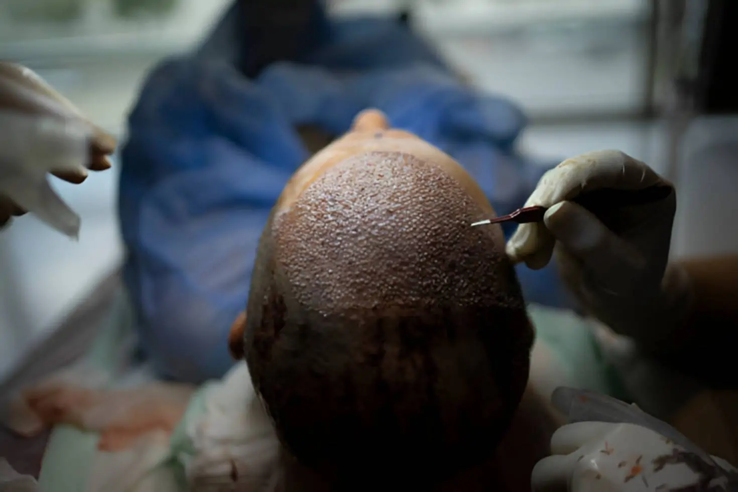 نتائج عملية زراعة الشعر
