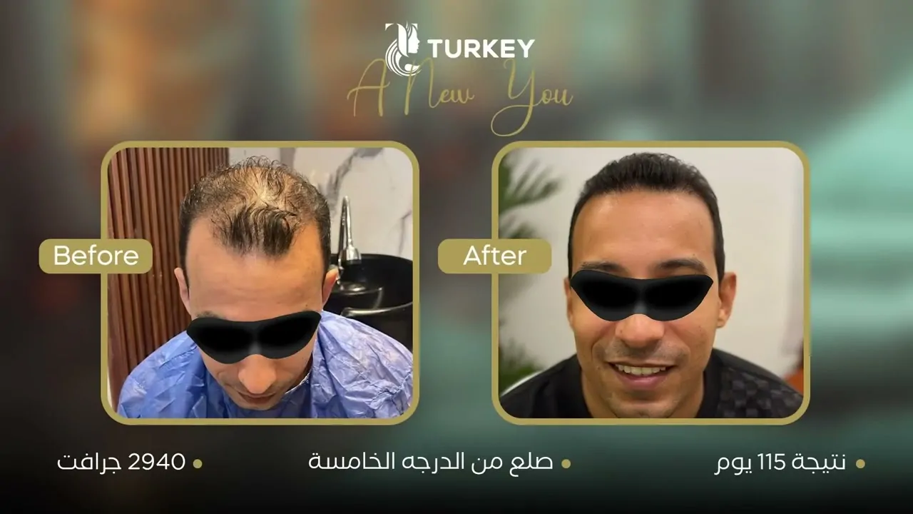 نتائج قبل وبعد زراعة الشعر بالصور