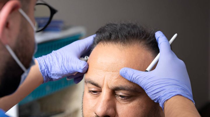 نجاح عملية زراعة الشعر