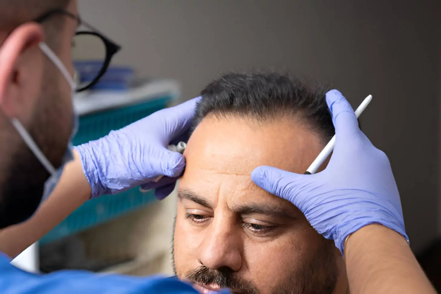 نجاح عملية زراعة الشعر