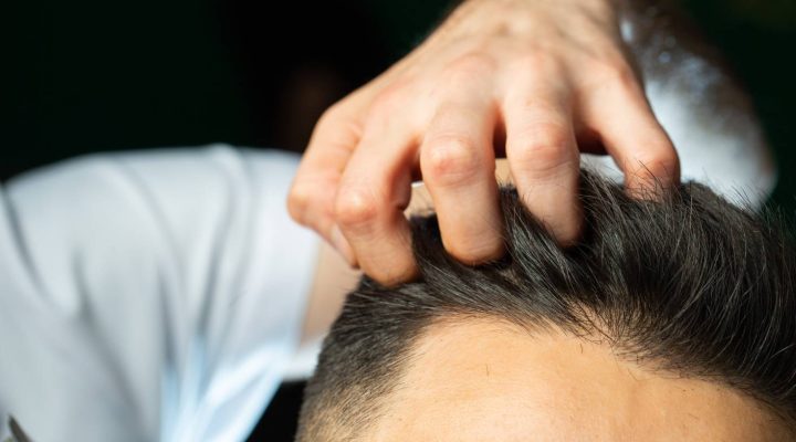 أحدث علاج للصلع