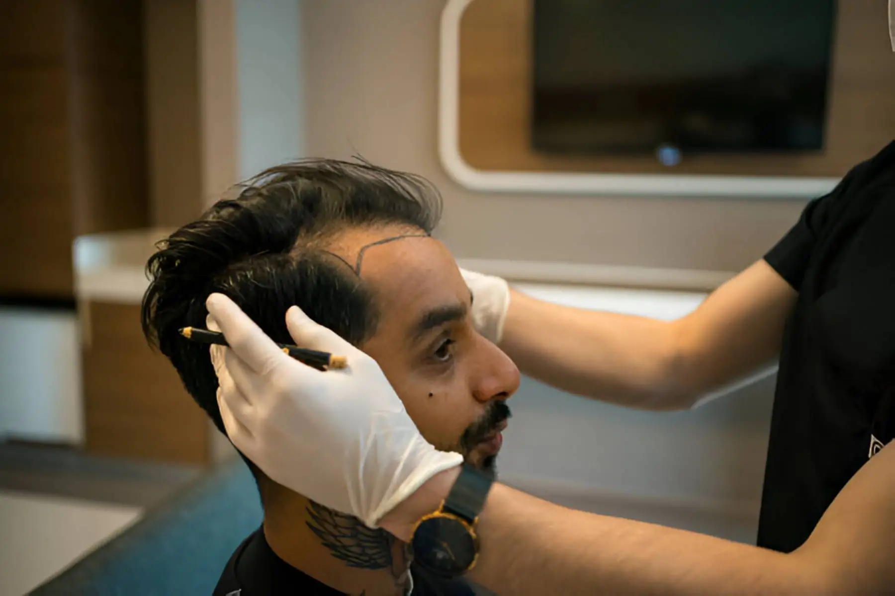 تكاليف زراعة الشعر
