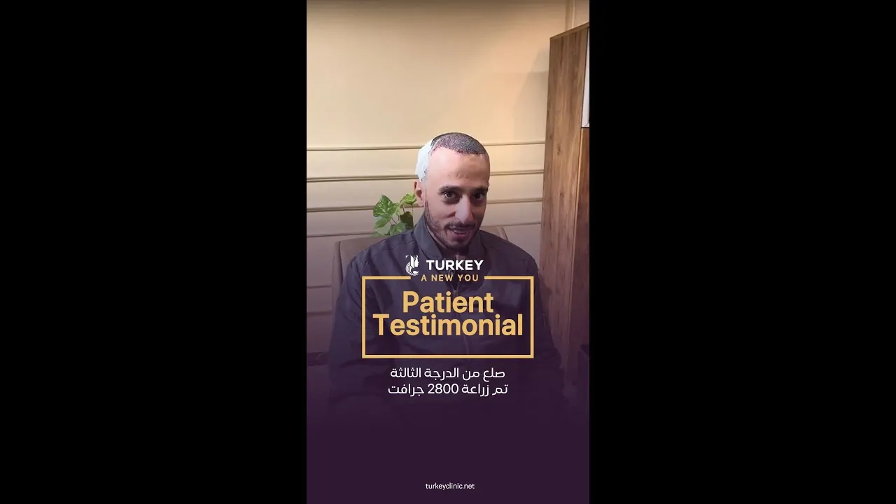 رأي عميلنا من أمريكا بعد زراعة الشعر