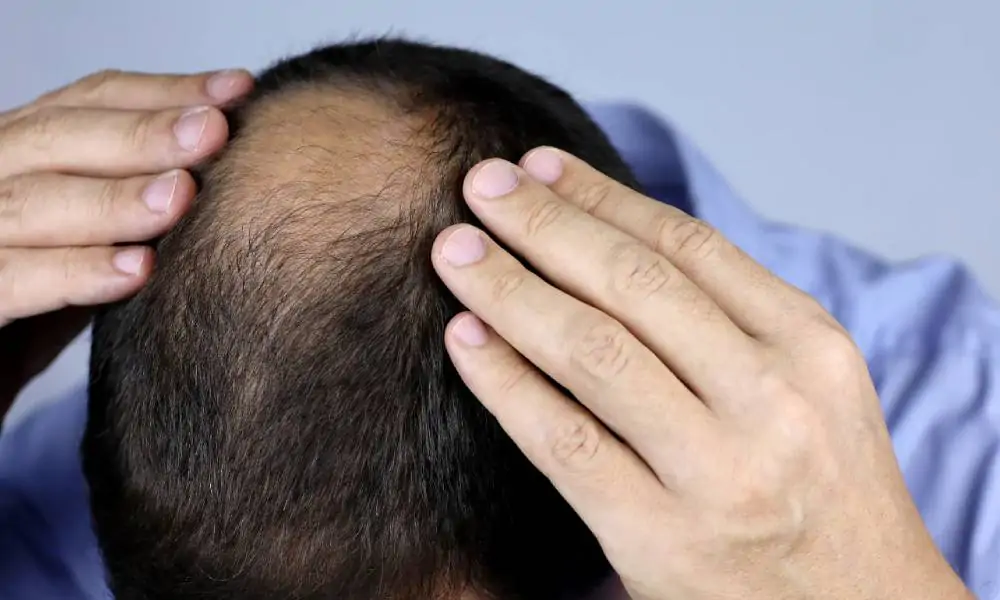 علاج الصلع الوراثي مجرب