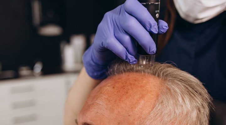 هل يمكن زراعة الشعر مرتين