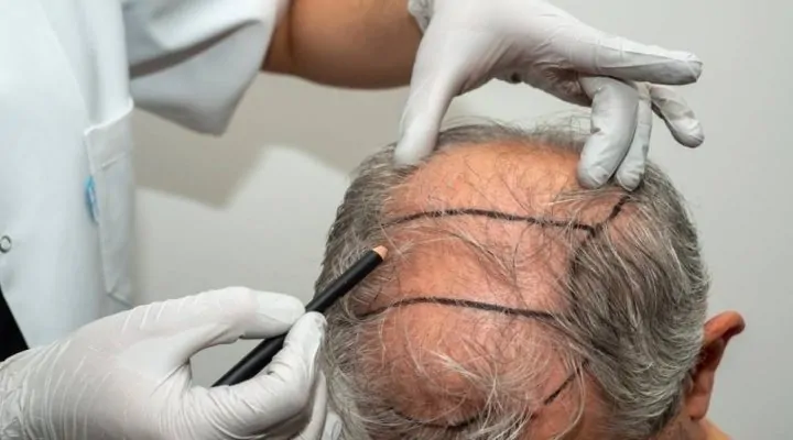 أحدث أجهزة زراعة الشعر