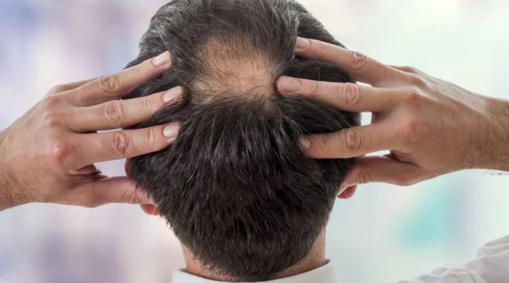 أفضل حل لتساقط الشعر