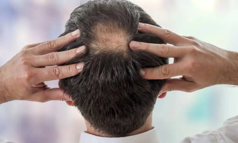 أفضل حل لتساقط الشعر