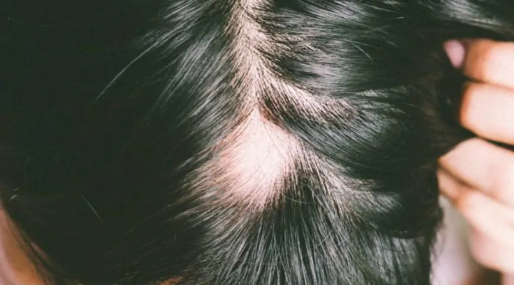 اسباب داء الثعلبه وعلاجه