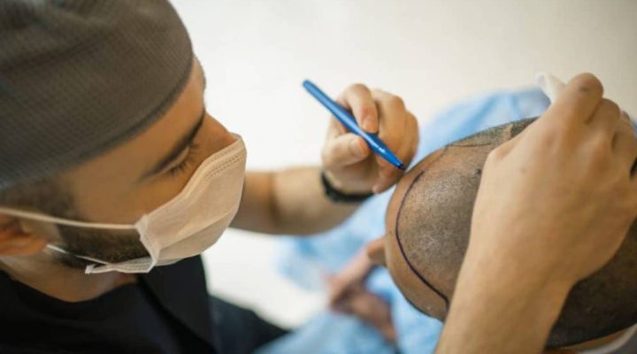 زراعة بصيلات الشعر