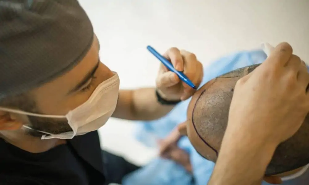 زراعة بصيلات الشعر