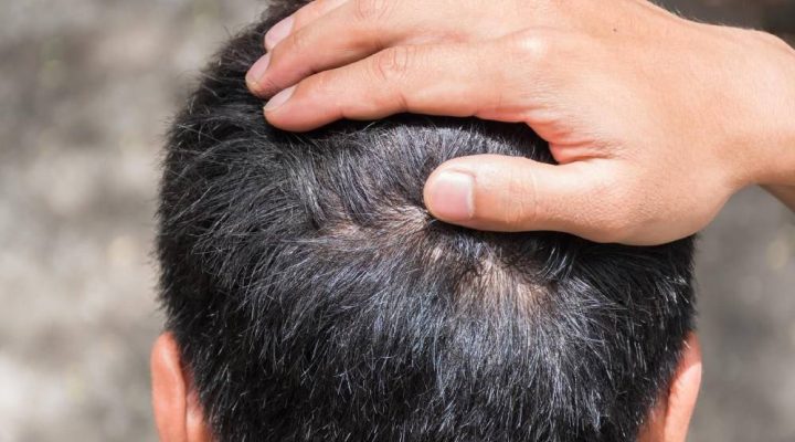 مدة شفاء المنطقة المانحة