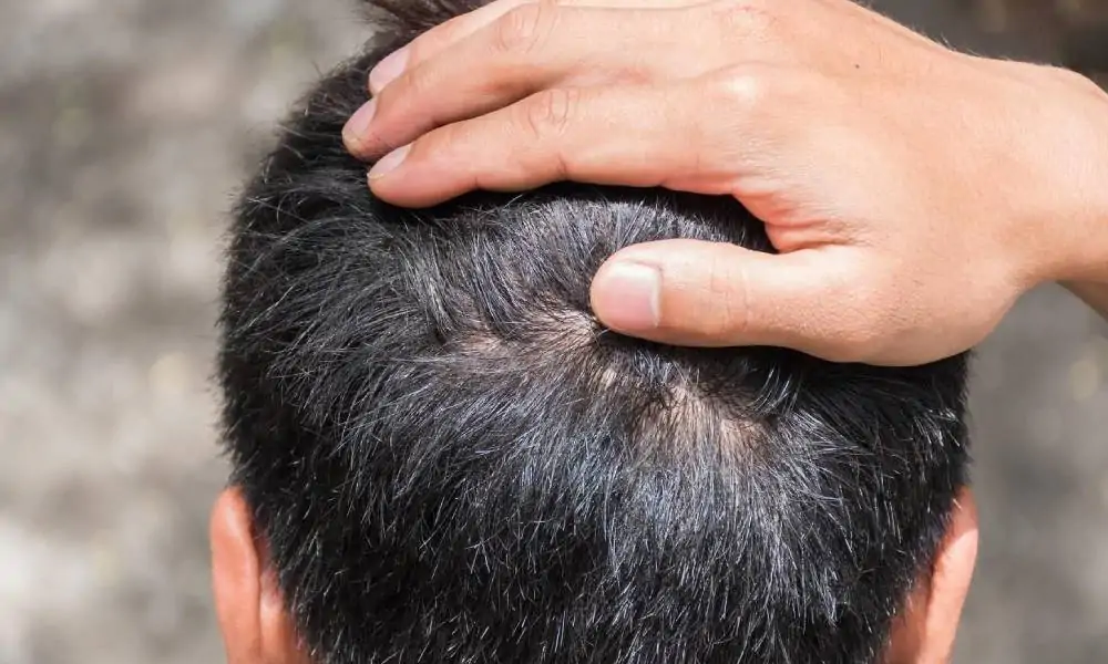 مدة شفاء المنطقة المانحة