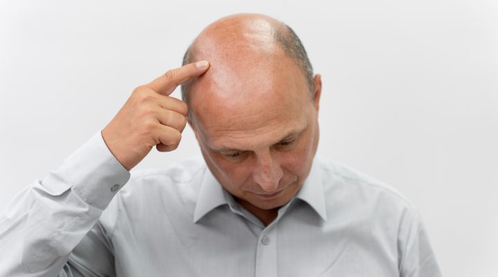 زراعة الشعر على مرحلتين