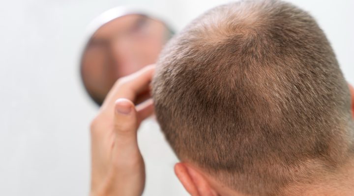 زراعة الشعر ومرض السكري