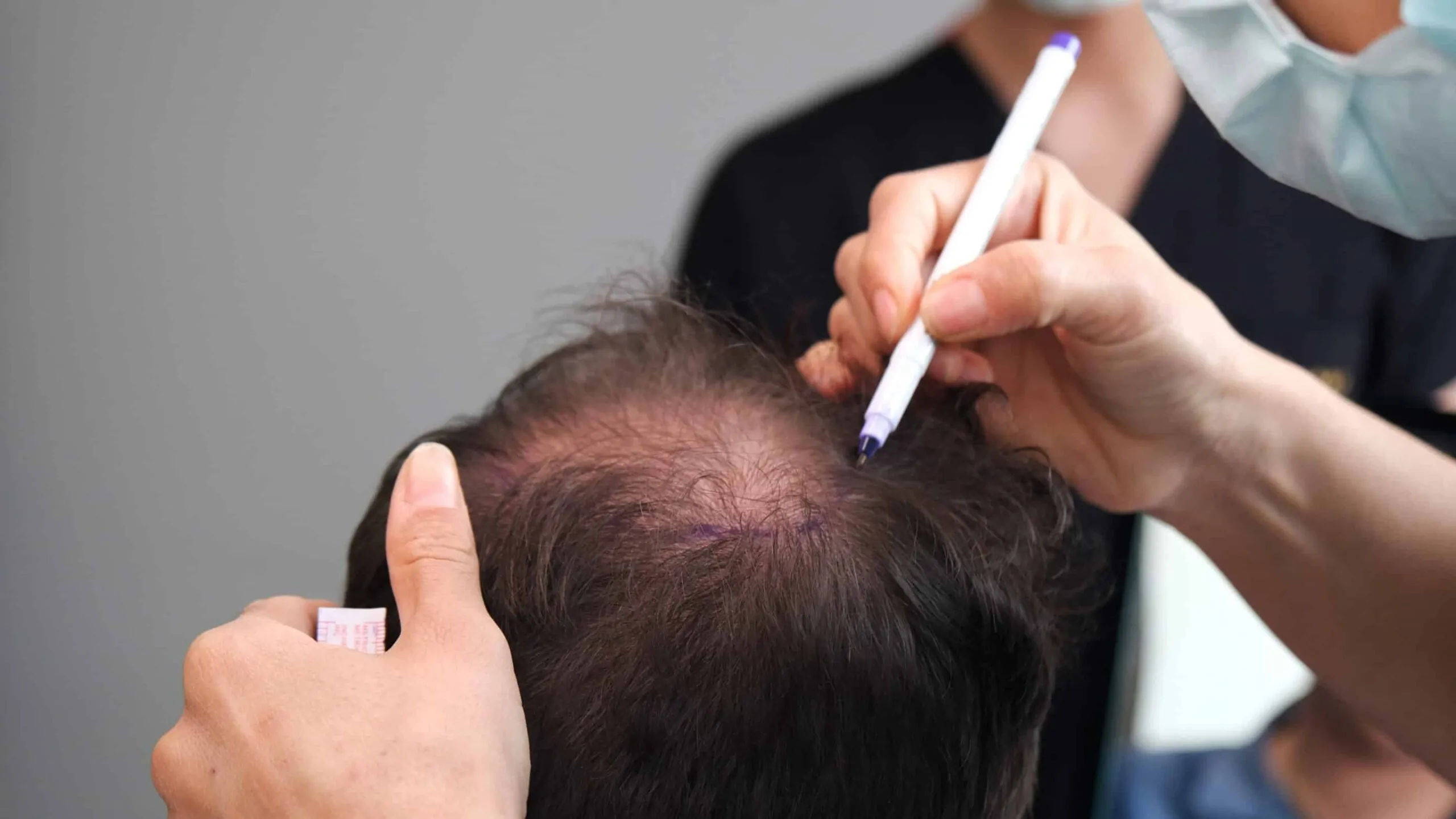 زراعة الشعر في منطقة التاج