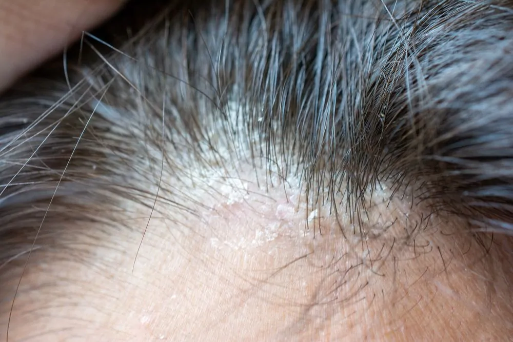 رعاية ما بعد زراعة الشعر للمصابين بالصدفية