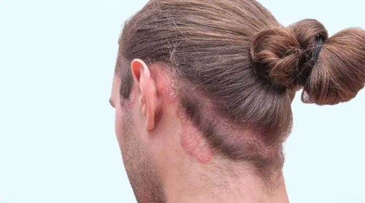 زراعة الشعر لمرضى الصدفية
