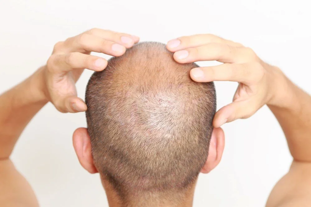 العلاج بالبلازما (PRP)