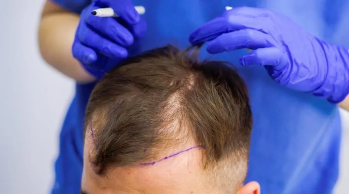 عملية تجميل الشعر