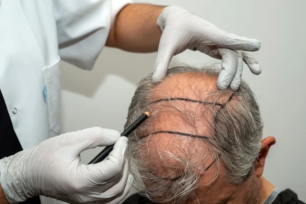 عملية زراعة الشعر بالليزر | هل هي ممكنة؟ وما الذي يميزها؟ 6 عملية زراعة الشعر بالليزر