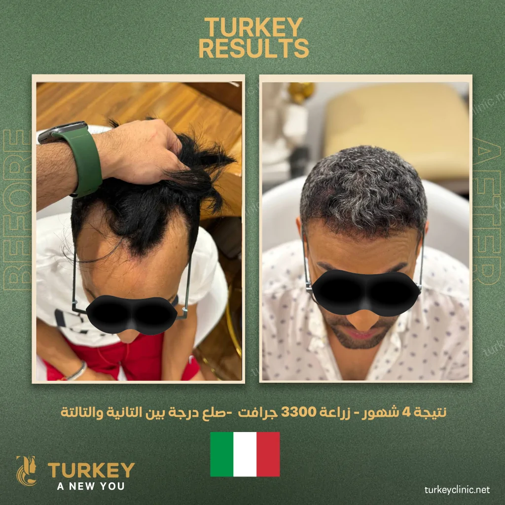 نتائج زراعة الشعر بعد 7 شهور بالصور 3 نتيجة 4 شهور زراعة 3300 جرافت صلع درجة بين التانية والتالتة