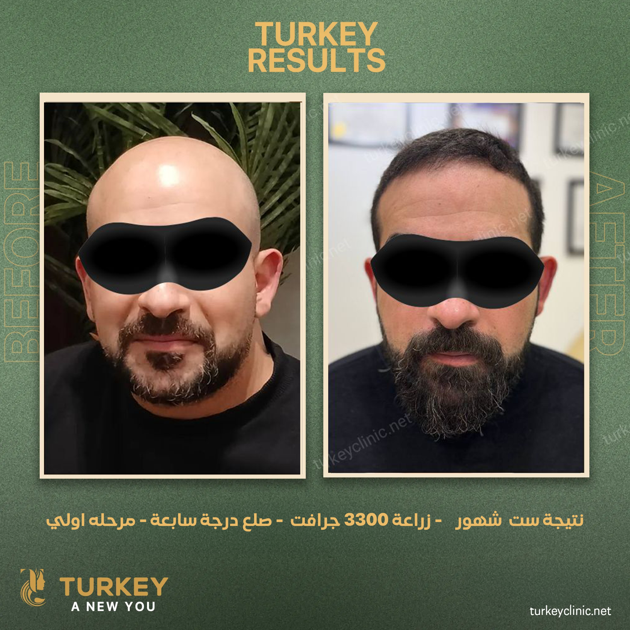 نتيجة 4 شهور زراعة 3300 جرافت صلع درجة بين التانية والتالتة