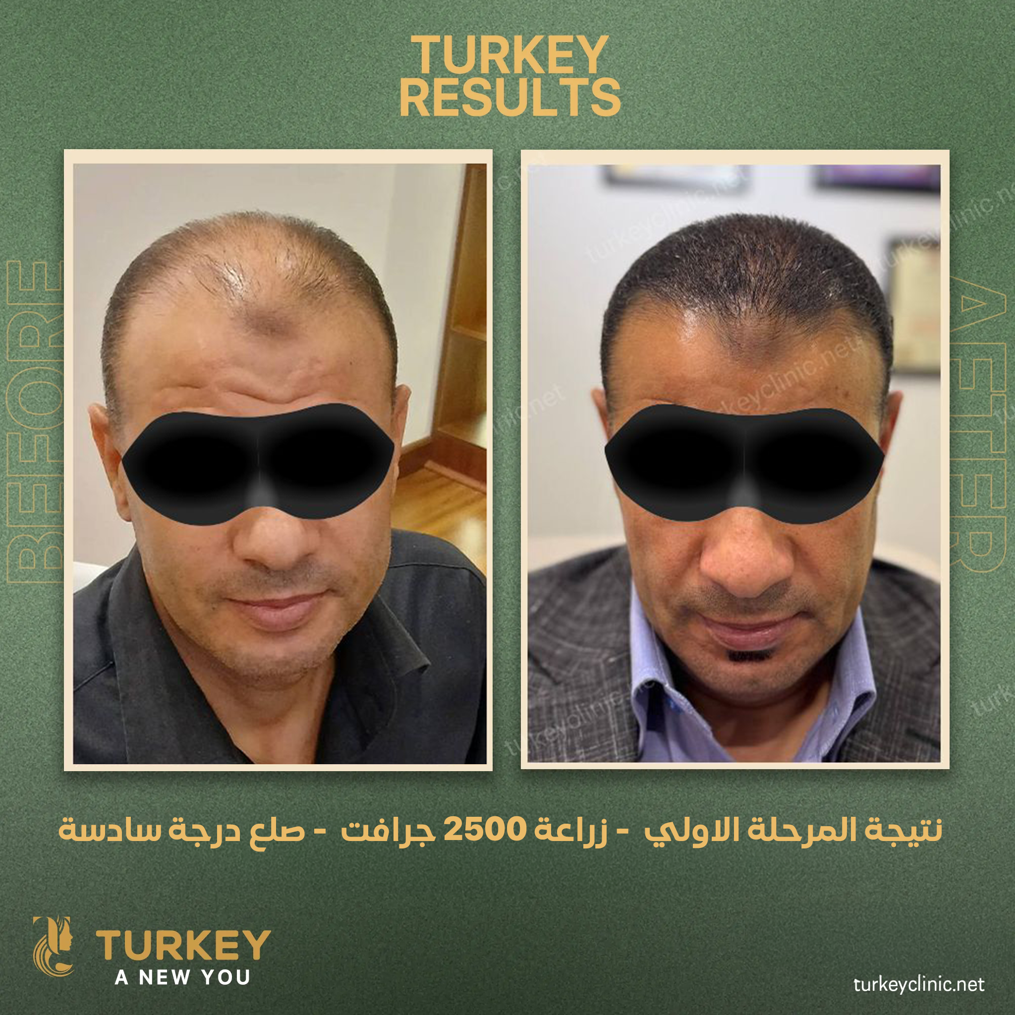 نتيجة المرحلة الاولي زراعة 2500 جرافت صبع درجة سادسة