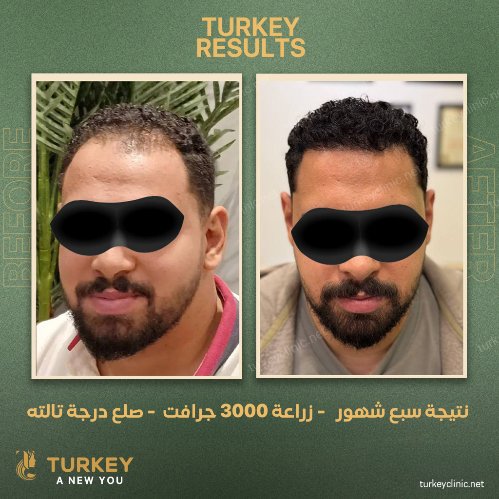 نتيجة سبع شهور زراعة 3000 جرافت صبع درجة تالتة