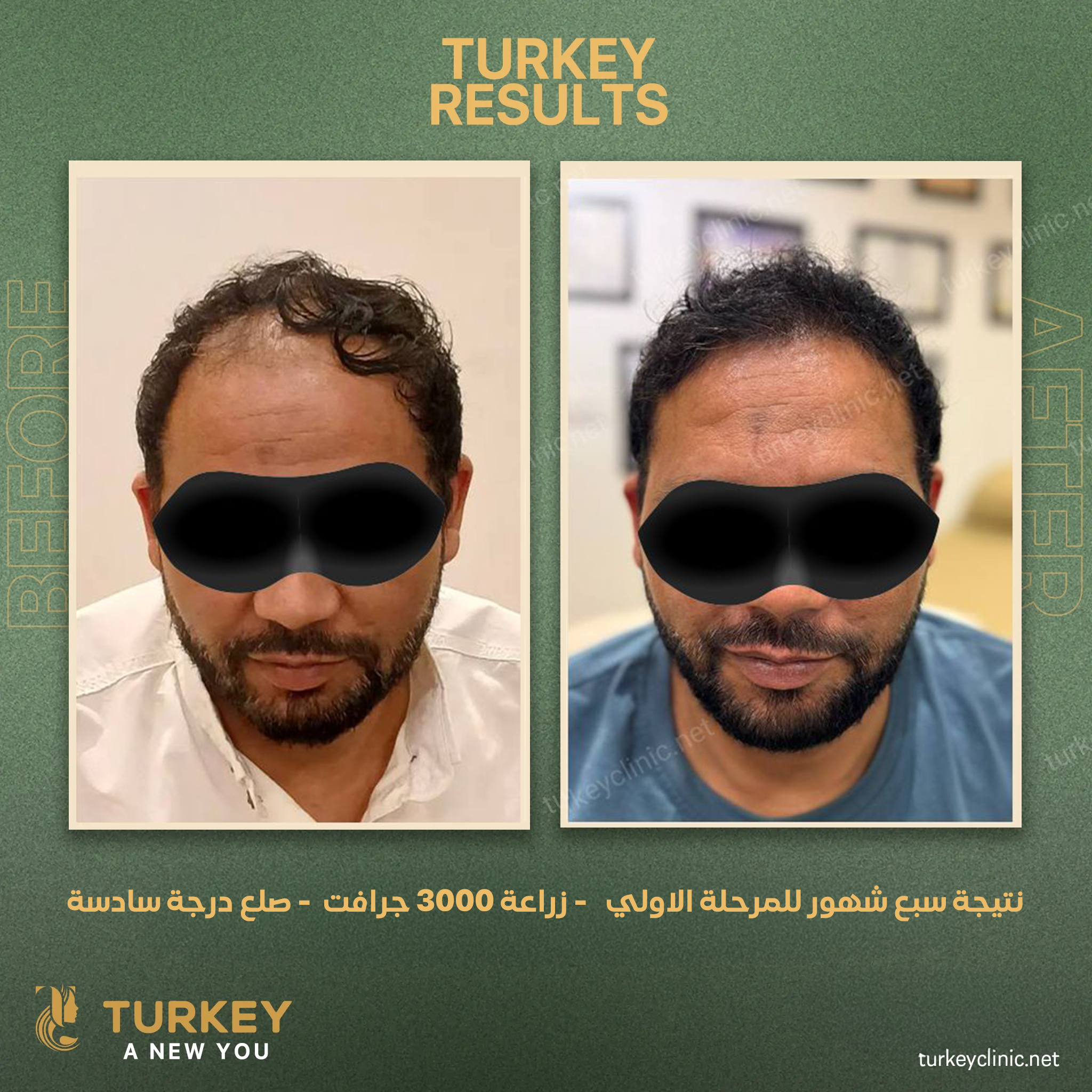 نتيجة سبع شهور للمرحلة الاولي زراعة 3000 جرافت صلع درجة سادسة