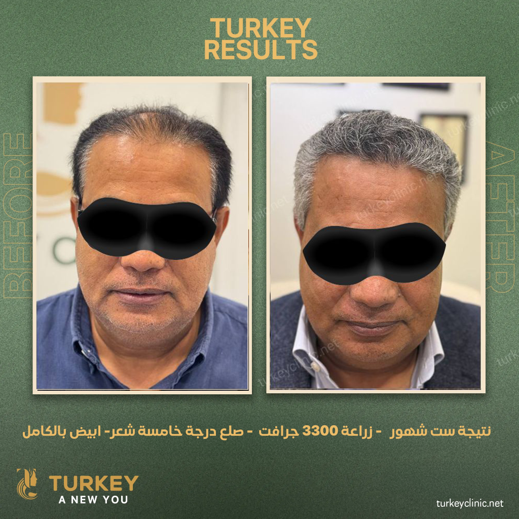 نتيجة ست شهور زراعة 3300 جرافت صلع درجة خامسة شعر ابيض بالكامل