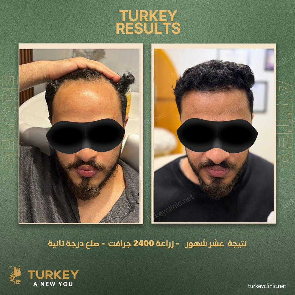 نتيجة عشر شهور زراعة 2400 جرافت صلع درجة تانية