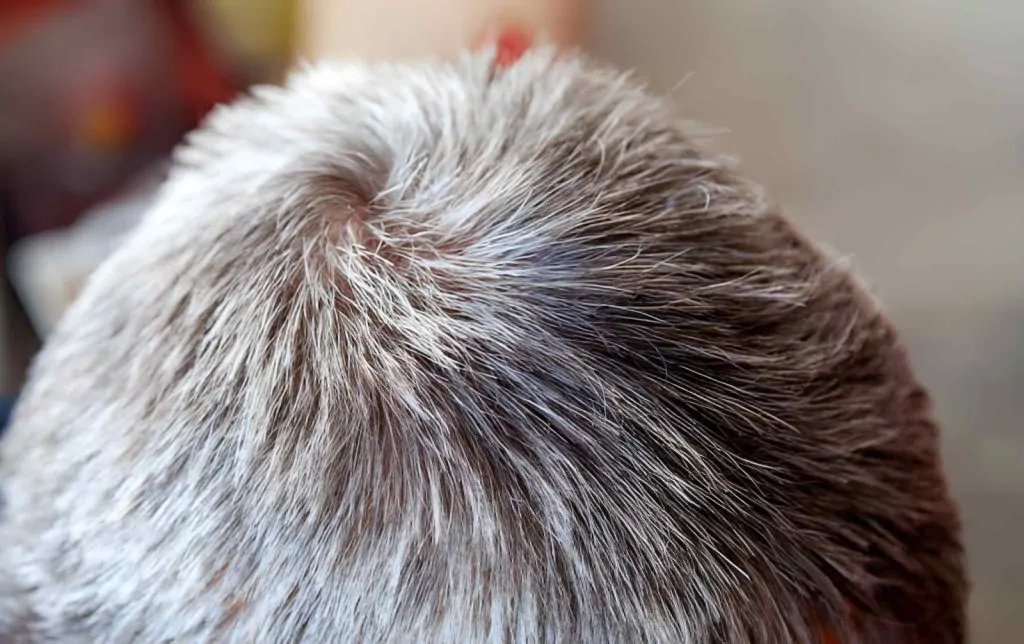 هل الشعر المزروع يشيب؟ الحقيقة و 5 أسباب للشيب 2 هل الشعر المزروع يشيب