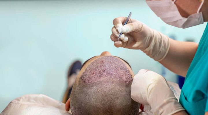 عدد بصيلات الشعر المزروع