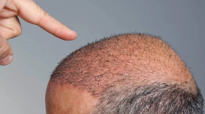 قبل وبعد زراعة الشعر