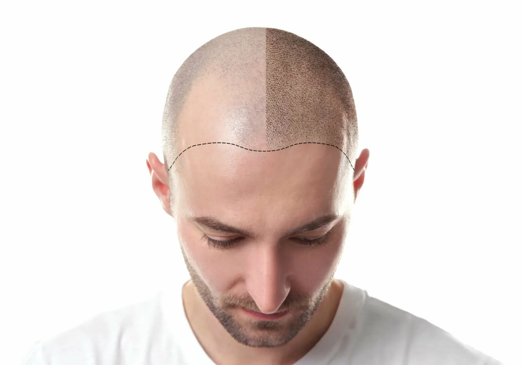 طرق الحفاظ على نتائج زراعة الشعر بعد 3 أشهر
