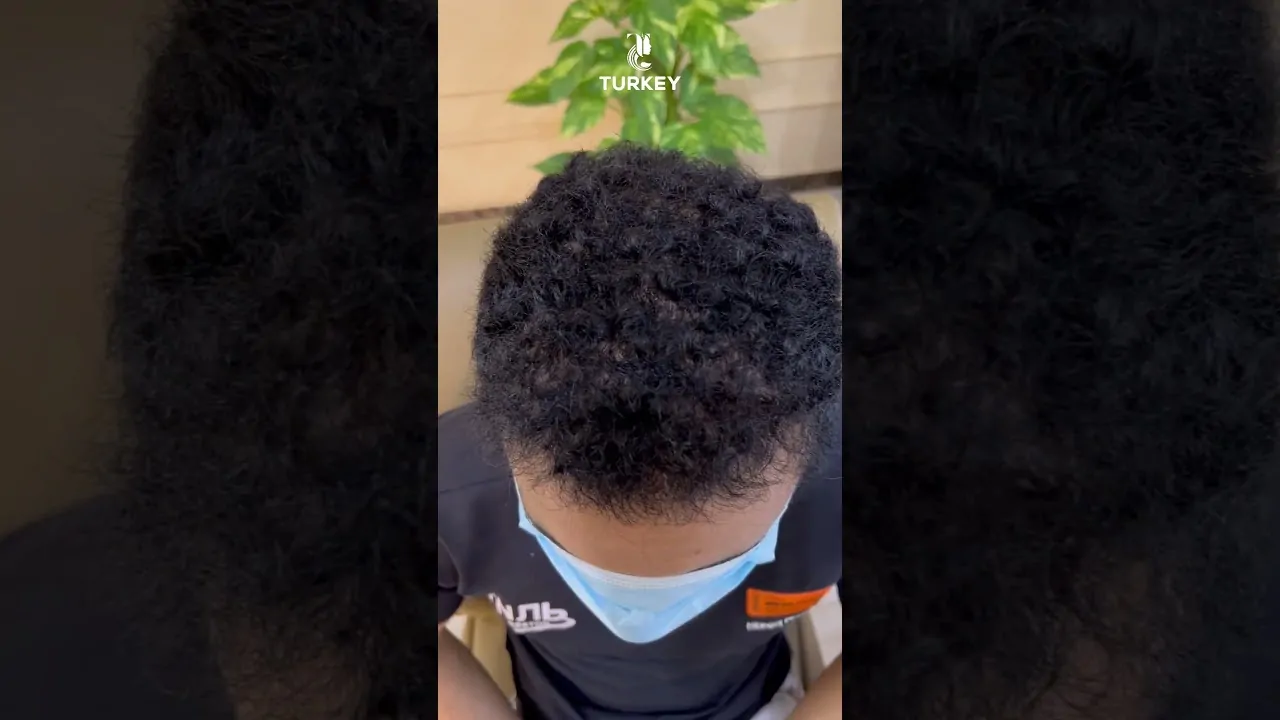 هل الشعر يتساقط بعد زراعة الشعر