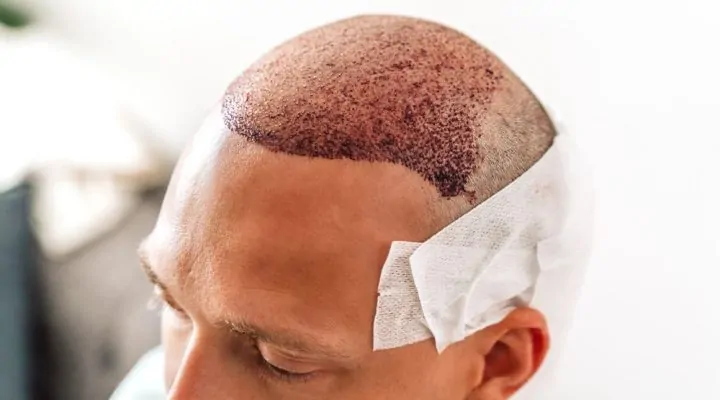الألم بعد عملية زراعة الشعر