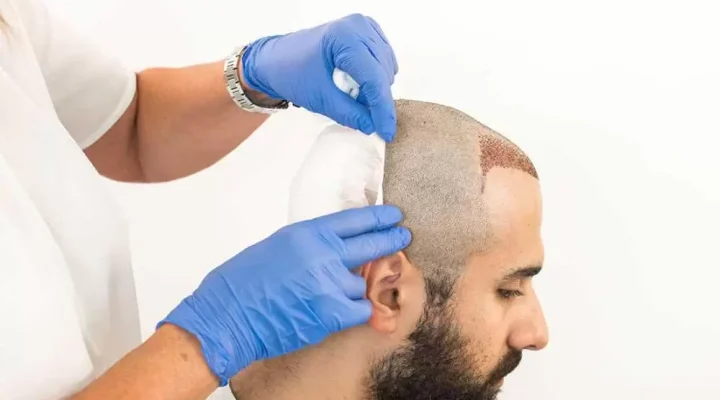 تورم الرأس بعد زراعة الشعر