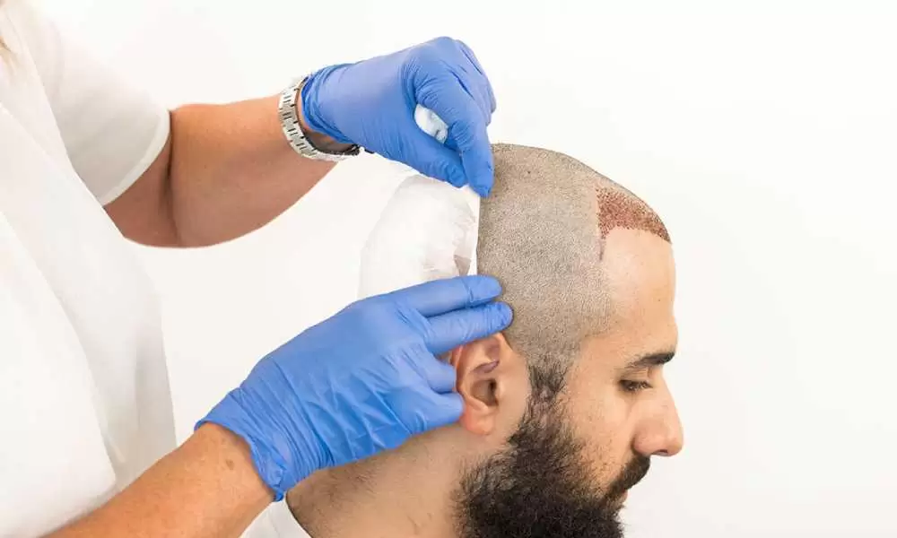 تورم الرأس بعد زراعة الشعر