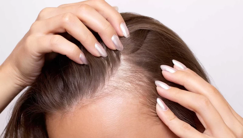 زراعة الشعر للنساء في مصر