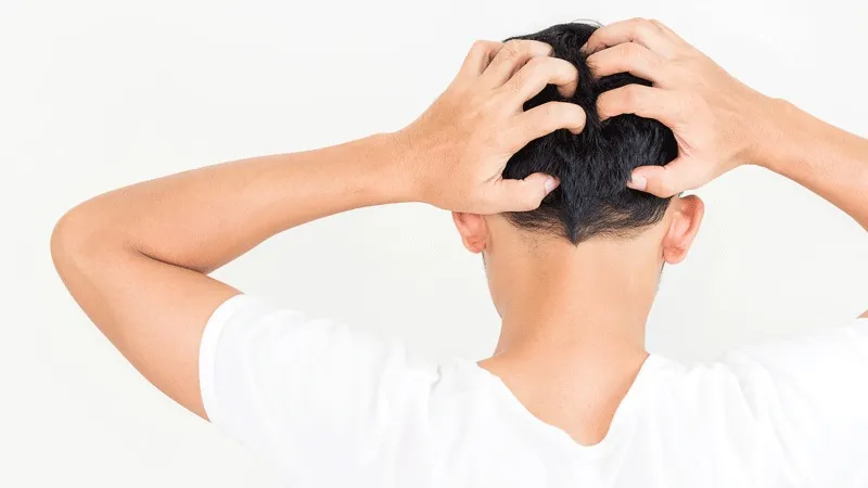 علاج حكة الراس بعد زراعة الشعر