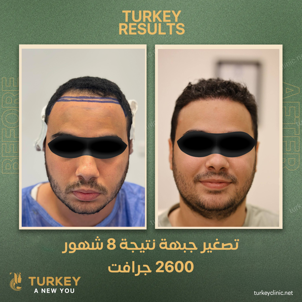 نتيجة تصغير الجبهة بزراعة الشعر بعد 8 شهور