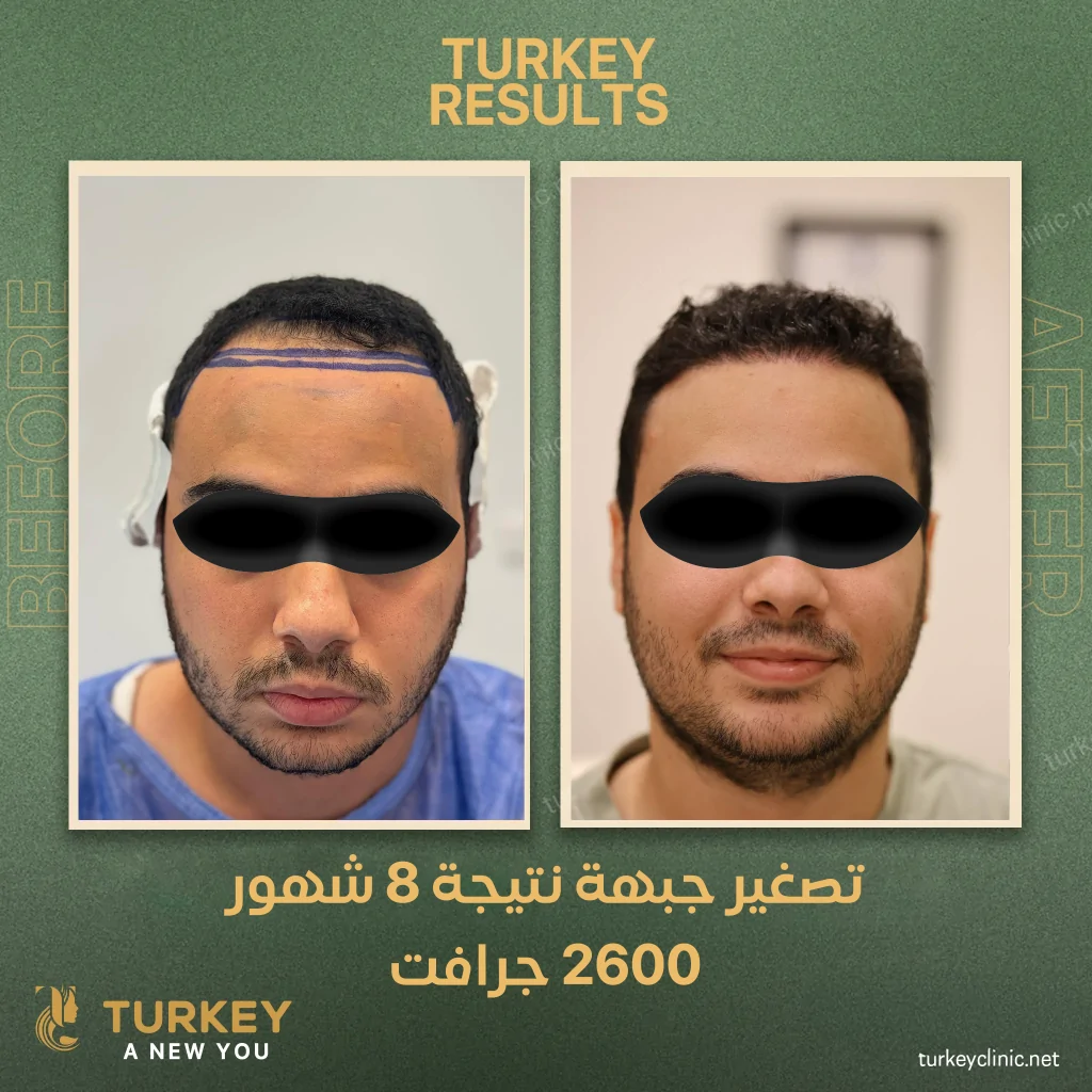 تكلفة زراعة خط الشعر الامامي 2025 5 نتيجة تصغير الجبهة بزراعة الشعر بعد 8 شهور